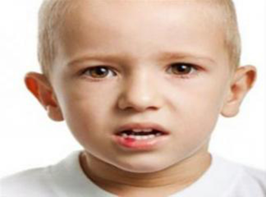 Çocuklarda Ağız Yarası Belirtileri ve Tedavisi